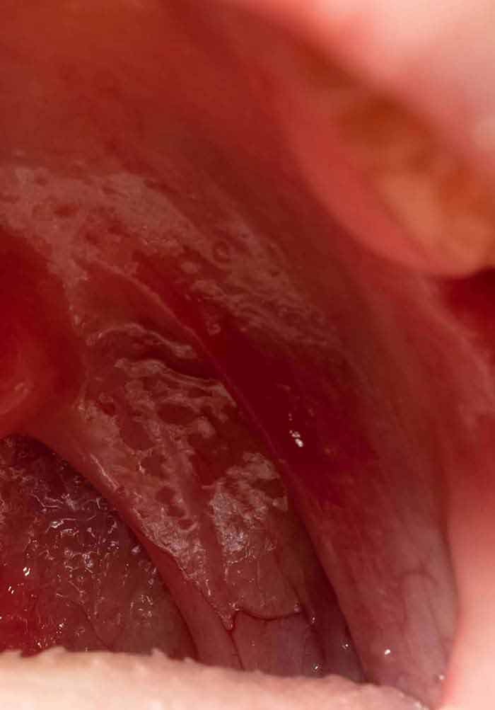 Pharyngeal squamous papilloma The epidemiology of hypopharynx and cervical esophagus cancer