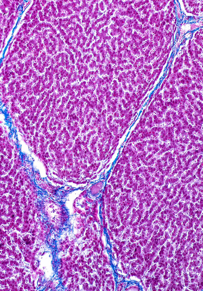 hepatocellular carcinoma gross
