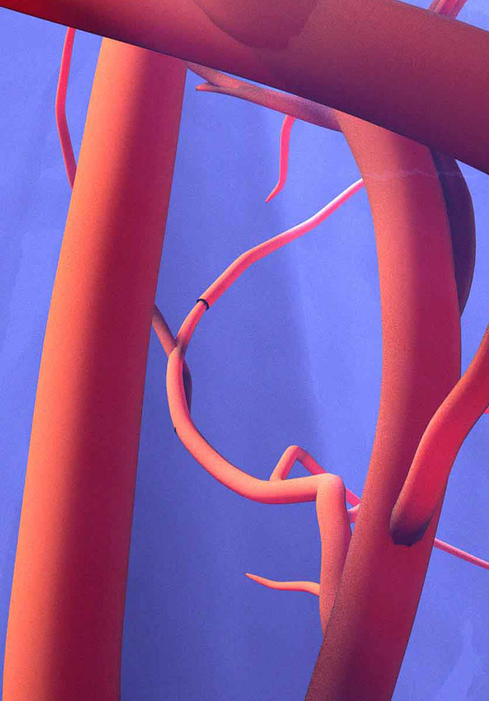 Peripheral Arterial Disease - The Challenges of Revascularization