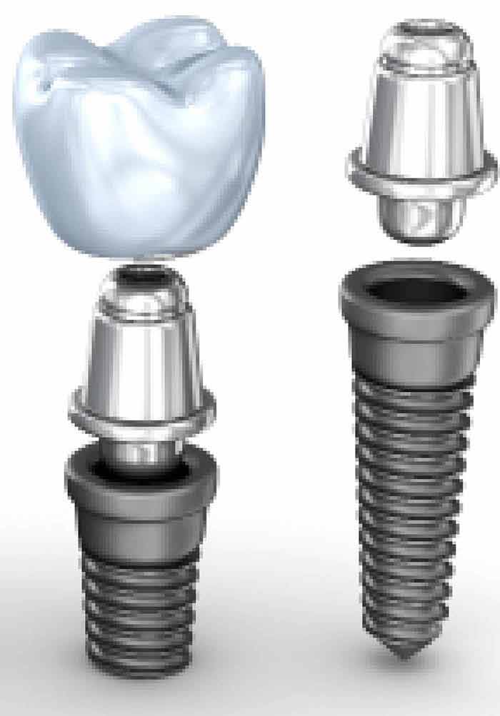 Dental implants: Mandibular neurovascular considerations 