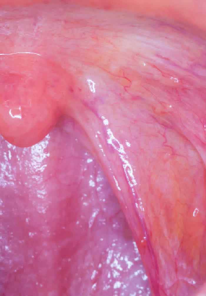 Hpv positive base of the tongue cancer