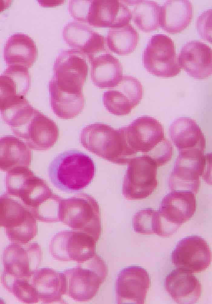 Detecting Hemoglobin Variants during Sickle Cell Disease Research
