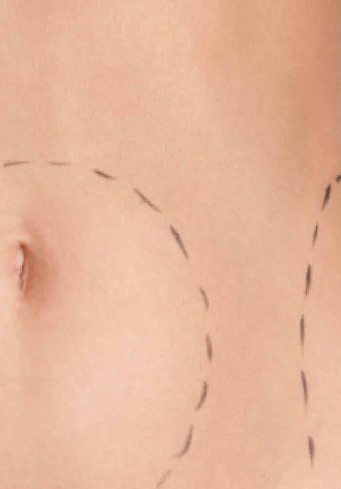 Circular Abdominoplasty (Belt Lipectomy) in Obese Patients