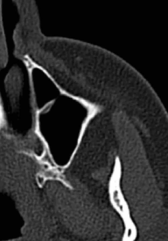 Paranasal Sinus Anatomy What The Surgeon Needs To Know Intechopen