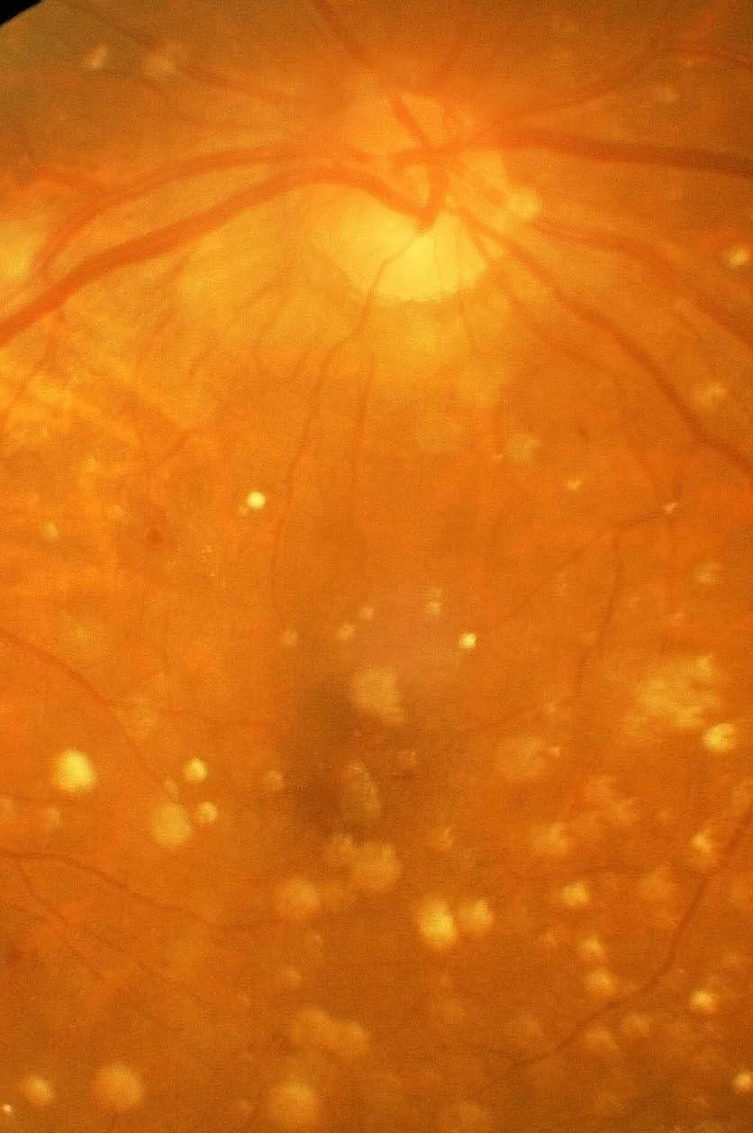 Retina Raleigh, Diabetic Retinopathy Raleigh