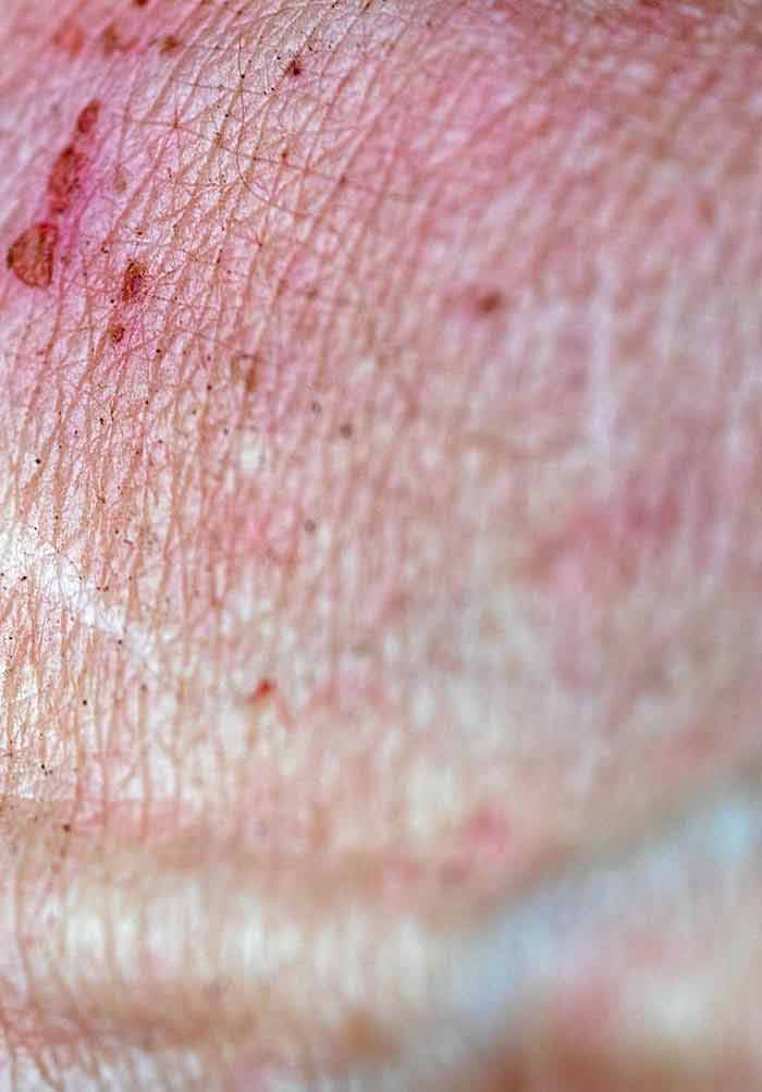 what is the underlying cause of psoriasis)